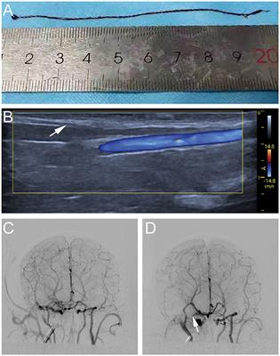 An Optimal Animal Model of Ischemic Stroke Established by Digital Subtraction Angiography-Guided Autologous Thrombi in Cynomolgus Monkeys